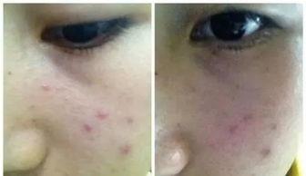 明星网红用什么去痘,揭秘去痘护肤秘籍